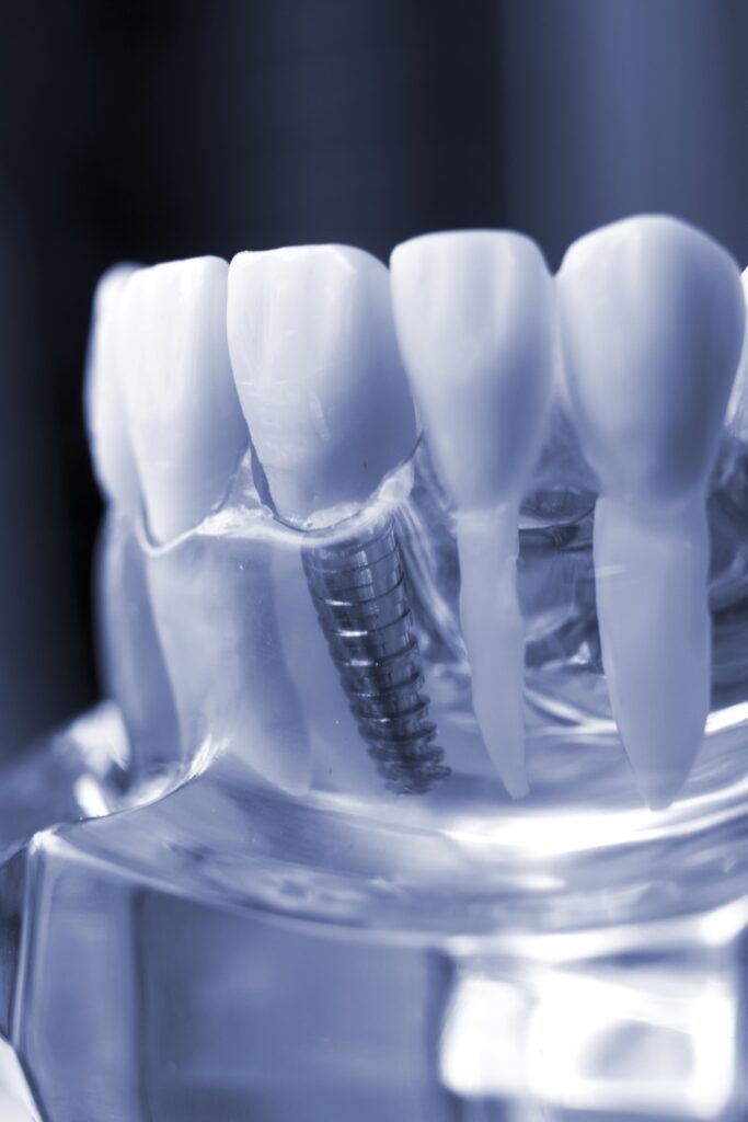 Поставяне на зъбни импланти в Europe Smile Clinic