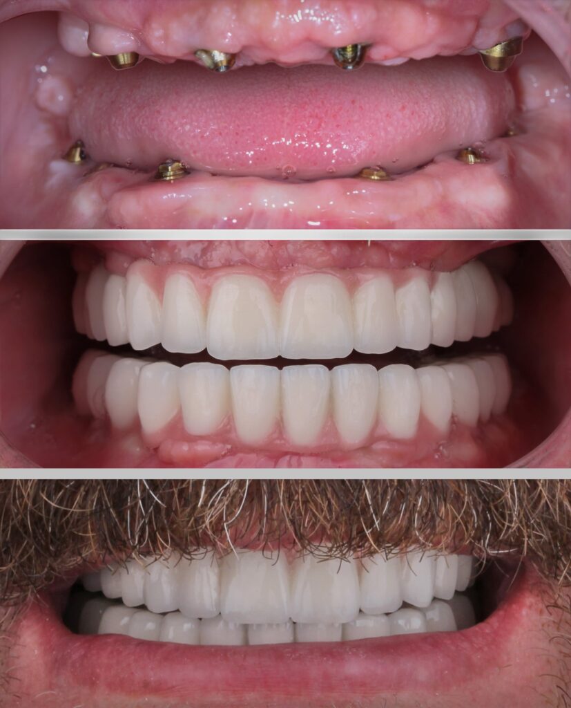 Поставяне на зъбни импланти по метода All-on-4 в дентална клиника Europe Smile Clinic